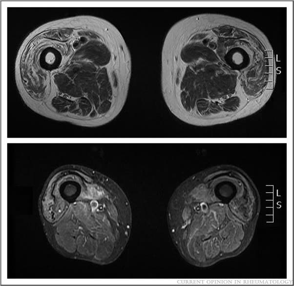 Inclusion body myositis MRI — 위고비 근손실, 감량의 84.5%는 지방이었습니다